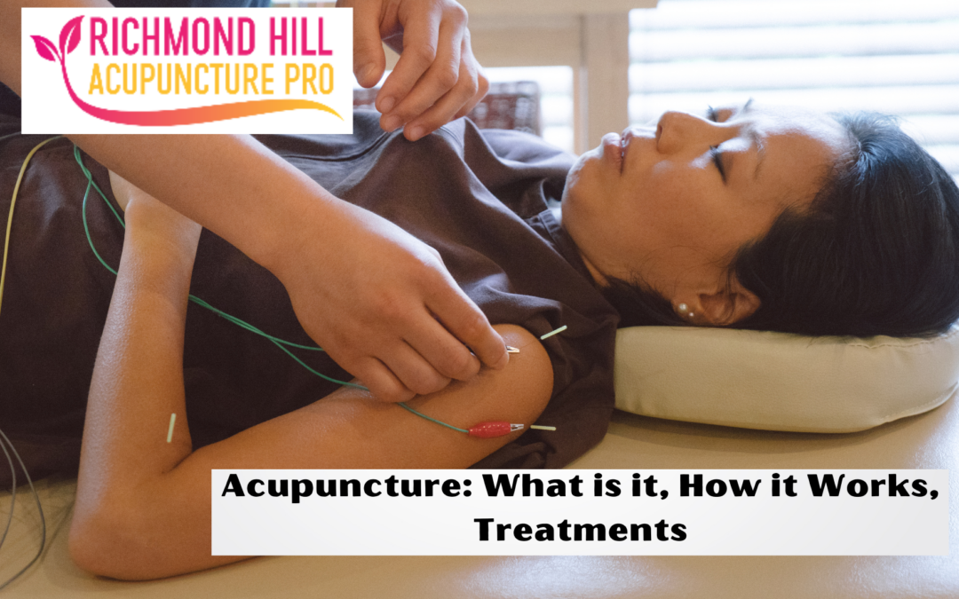 Acupuncture What is it, How it Works, Treatments